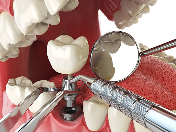 Best Root Canal Emergency Dentist  in Lemon Hill, CA